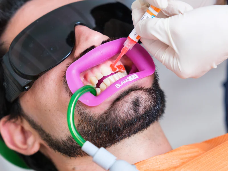 Pulizia dentale su un paziente
